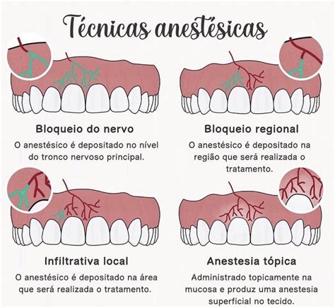 Problemas O Bloqueio Do Nervo Alveolar Inferior Odontologia Dra Hot