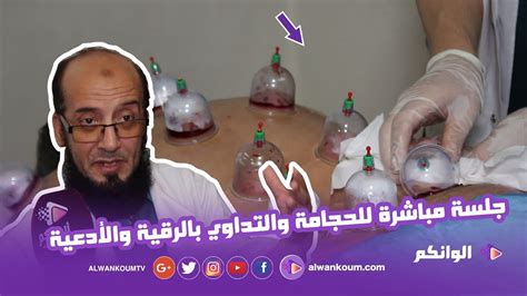 بالفيديو هذا ما لا تعرفونه عن الحجامة وتفاصيل إخراج الدم الفاسد من