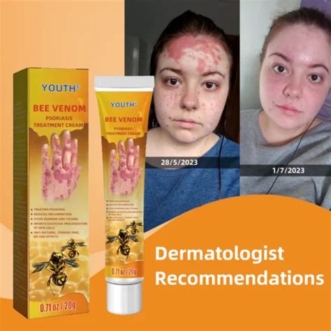 Bee Venom Psoriasis Treatment Cream - Moonqo Store