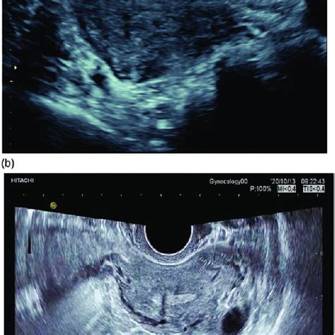 A And B Three Dimensional Transvaginal Ultrasonographic Images Of