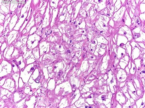 Cardiac Rhabdomyoma : Histology