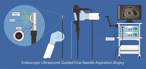 Endoscopic Ultrasound Eus In Singapore Gastrohealth Clinic