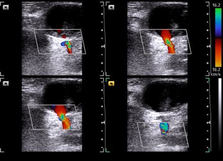 Femoral Artery Ultrasound