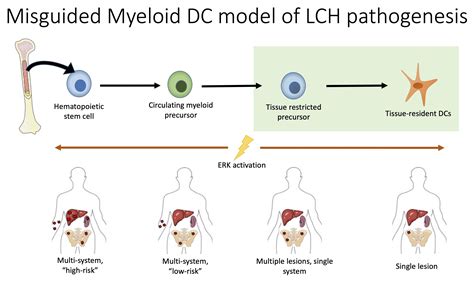 Pathology Outlines Langerhans Cell Histiocytic Neoplasms