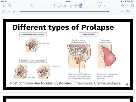 Obgyn Flashcards Quizlet