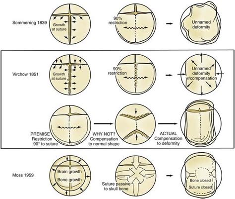 Craniosynostosis Sutures