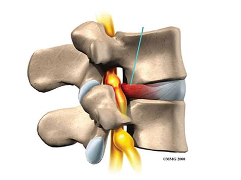 Understanding Lumbar Disc Prolapse And Lumbar Discectomy Spineplus