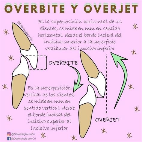 Overbite Y Overjet Zahnmedizin Medizin Posselt