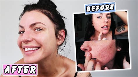 How To Clear Your Acne Skin Transformation Youtube