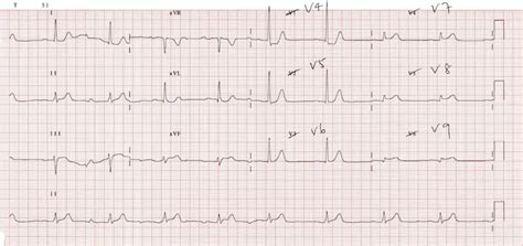 Posterior Wall MI ECG