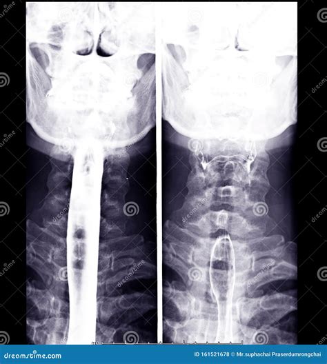 Esophagram Or Barium Swallow AP And Lateral View Showing Esophagus For