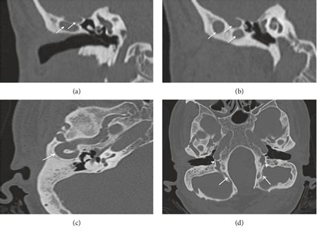 Figure 1 From Bilateral Severely Stenotic Jugular Foramen Diagnosis