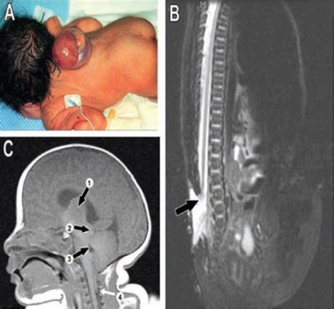 Images Showing A Newborn With Thoracic Myelomeningoce Open I