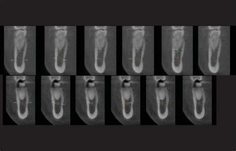 Inferior Alveolar Nerve Course