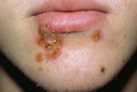 Pictures Of Skin Infections