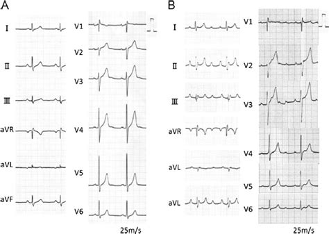 A Surface 12 Lead Electrocardiography ECG During Sinus Rhythm B