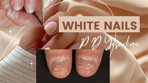 White Nails Or Leukonychia Causes And Treatment Youtube