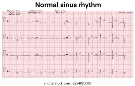 Electrocardiogram Show Normal Sinus Rhythmecg Ekg Stock Illustration ...