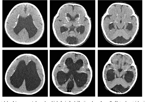 Figure 1 From Congenital Infection Like Syndrome With Intracranial