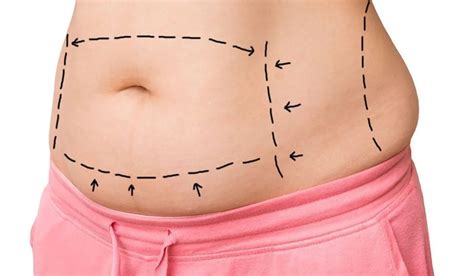 Wondering What Is Liposuction Heres Everything You Need To Know