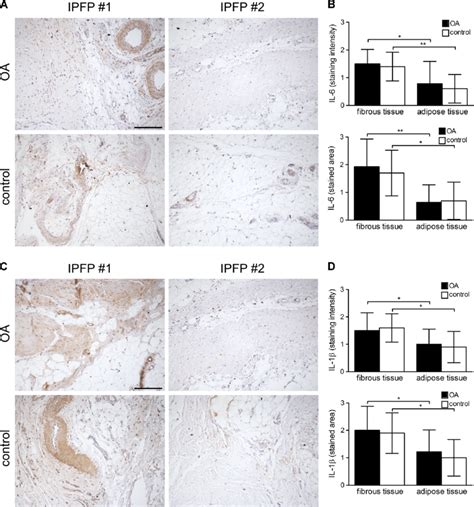 Immunohistochemical analysis of interleukin 6 IL 6 and IL 1β