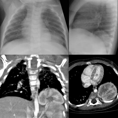 Congenital Diaphragmatic Hernia Pediatric Radiology Reference Article