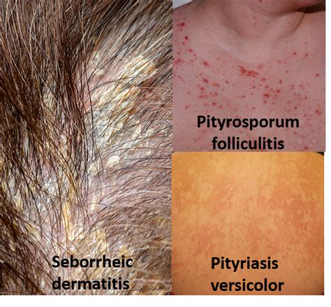 Malassezia Dermatitis On Scalp