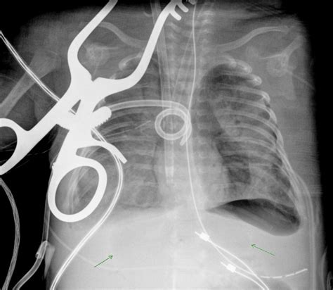 Pedi cardiology: X-ray: Pneumomediastinum vs. Pneumopericardium