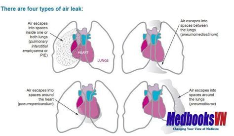 Air leak syndrome PDF |Free Medical Books : r/usmlestudymaterials