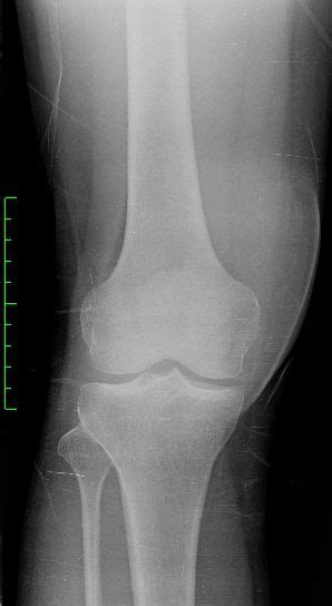 Prepatellar Bursitis Image