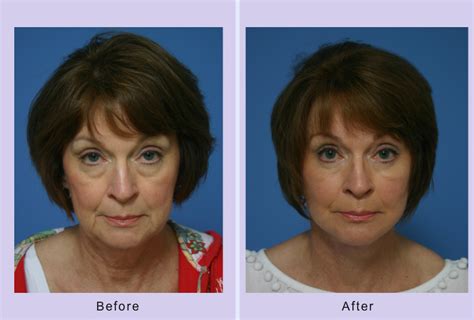 This Patient Underwent A Pinch Lower Blepharoplasty And Facelift