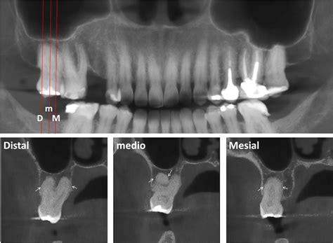 Hipercementosis Dento Metric Radiología Dental Oral Y Maxilofacial