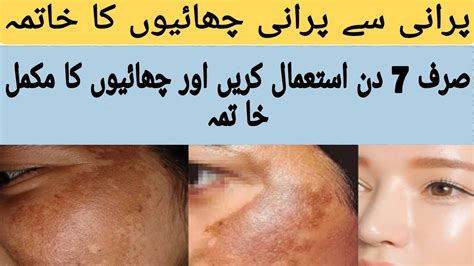 How to get rid of face pigmentation چہرے کی چھائیوں کو کیسے ختم کریں