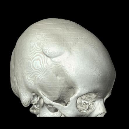 Skull Vault Osteoma Radiology Case Radiopaedia Org