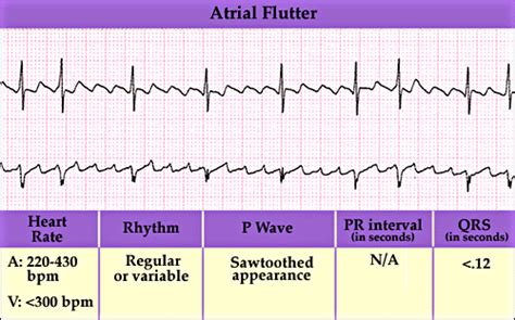 Atrial Flutter Natural Blood Pressure, Healthy Blood Pressure, Nursing School Tips, College ...