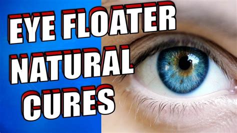 What Are Eye Floaters How To Treat Eye Floaters Naturally YouTube