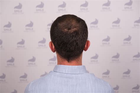 Grafts Fue Hair Transplant Months Before After Results