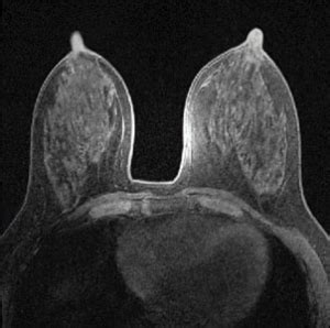 Abbreviated Screening Breast Mri Triad Radiology Associates