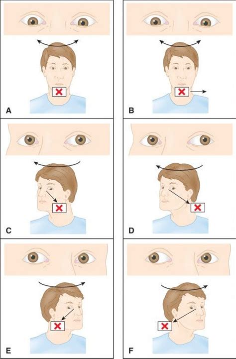 vestibular rehabilitation