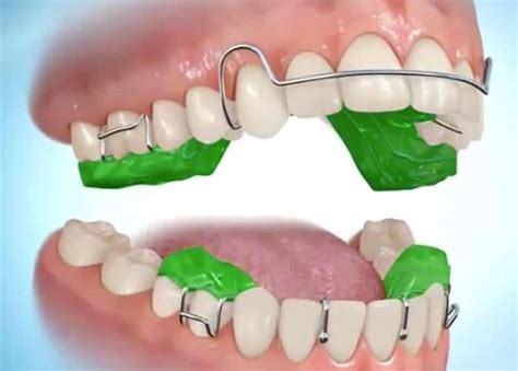 Types Of Treatment Hawkes Bay Orthodontics