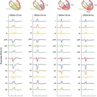 Representative Lead Ecg For Qrs Interval At Intrinsic And Three