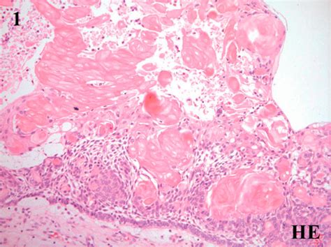 Calcifying Epithelial Odontogenic Tumor Histology