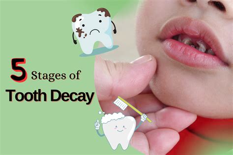 What Are The Five Stages Of Tooth Decay