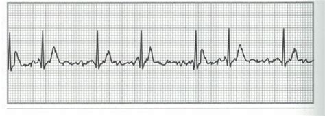 Nha Module 13 Ekg For Chapter 26 Test Flashcards Quizlet