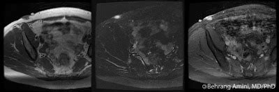 Roentgen Ray Reader: Dermatofibrosarcoma Protuberans