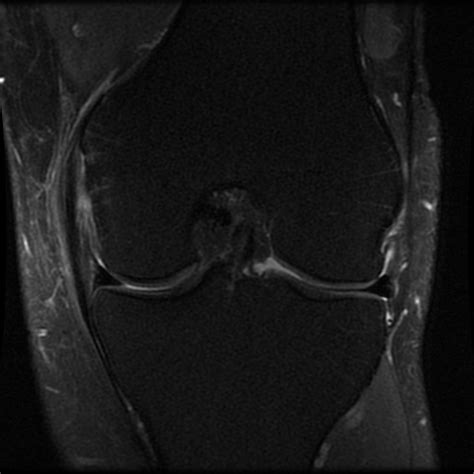 Medial Collateral Ligament Mri