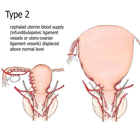 The Large Uterus Classification System Type 1 Large Fundal