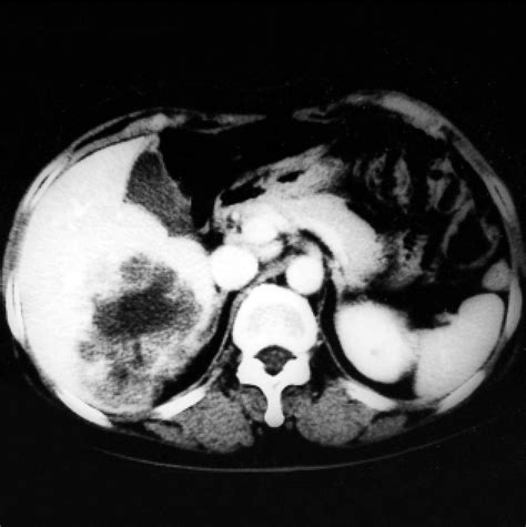 Figure 1 From Hepatic Resection Of Metastatic Tumor From Serous