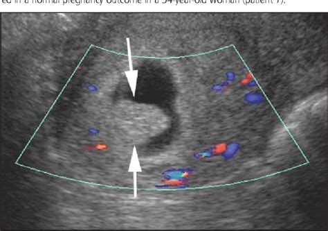 Figure 2 from The chorionic bump: a first-trimester pregnancy ...