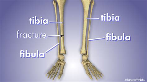 What Is Tibia And Fibula Fracture / Fibula Fracture Symptoms Treatment ... 